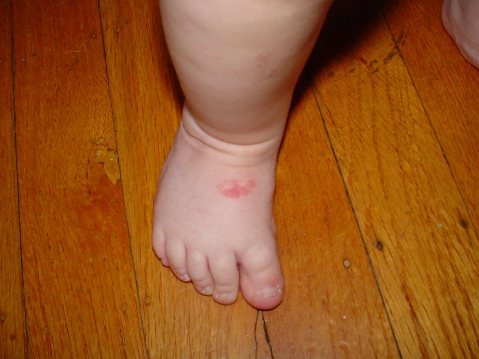 Normal toes gripping when first learning to balance and walk - Right Clubfoot