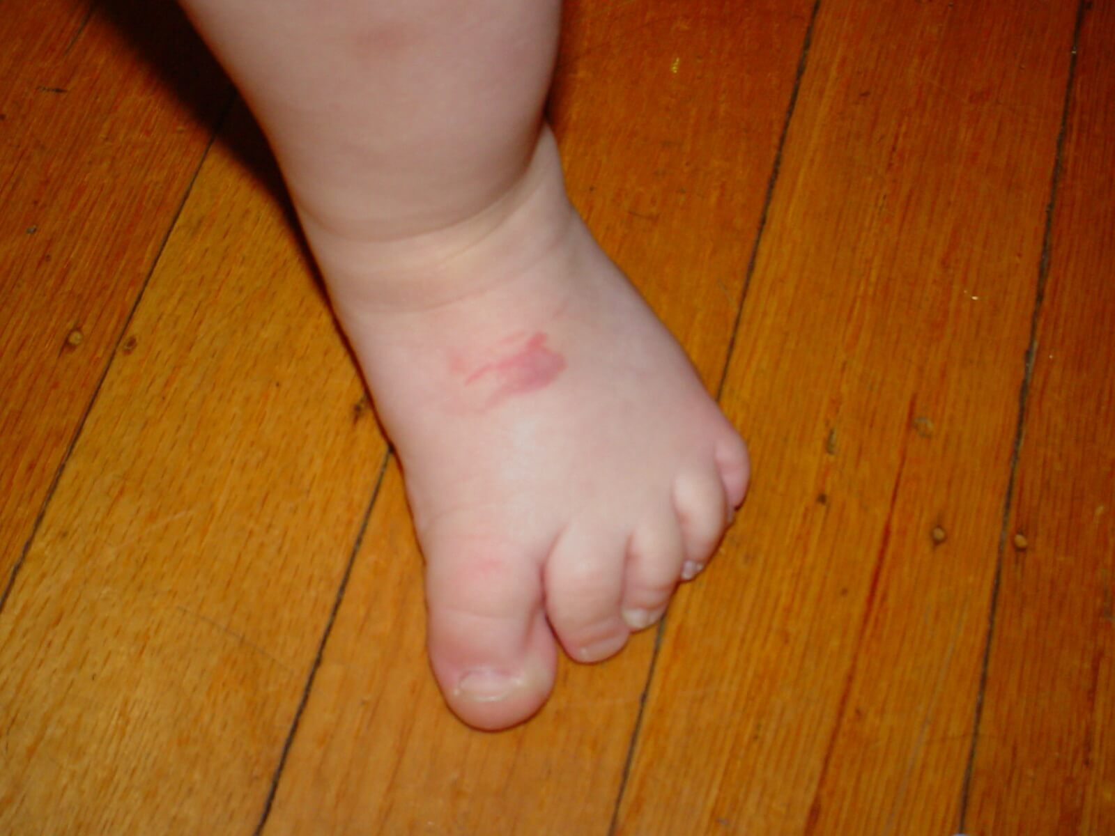 Normal toes gripping when first learning to balance and walk - Right Clubfoot