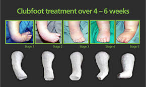 Clubfoot treatment over 4-6 weeks