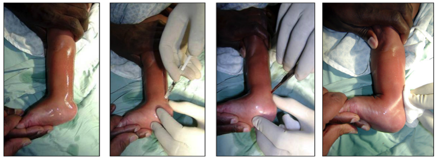 Achilles Tenotomy Surgical Procedure, Four Stages -  Pictures from left: 1.  Cleaning the Skin 2.  Injecting Local Anaesthetic 3.  The Tenotomy 4.  Increased dorsiflexion after Tenotomy