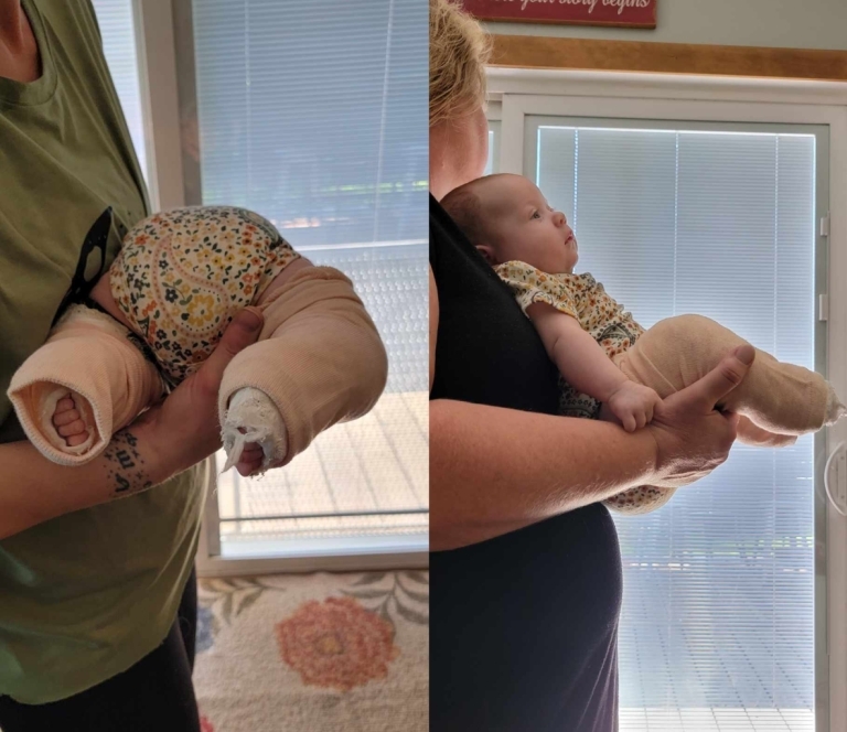 Holding Baby with Casts - Prone Hold & Chair Hold