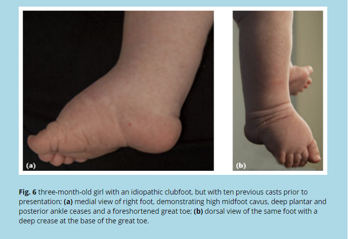 Challenging clubfeet: the arthrogrypotic clubfoot and the complex clubfoot
