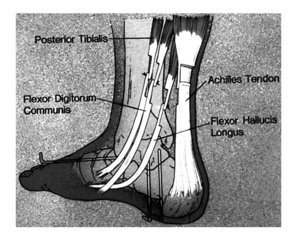 Tendons released during the PMR Surgery