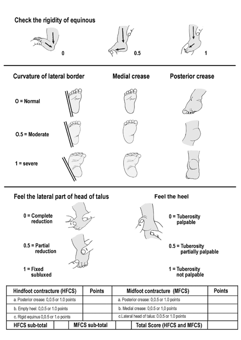 Pirani Score Sheet - From Research on Clubfoot Management by the Ponseti Technique in Saudi Patients
