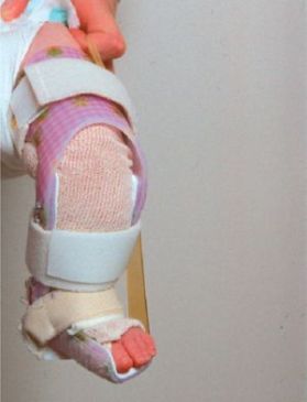KAFO - Knee Ankle Foot Orthosis