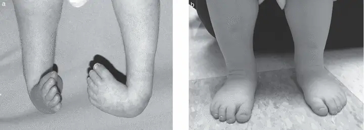 Figure 1 (a) Bilateral congenital talipes equinovarus deformity occurring in a male patient with trisomy 18, before treatment at age 1 month and (b) after treatment at age 3 years This patient was treated with the Ponseti method of serial casting which required a total of six casts applied weekly between the ages of 1 and 3 months.