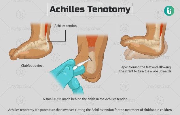 Achilles Tenotomy, a minimally invasive surgical procedure