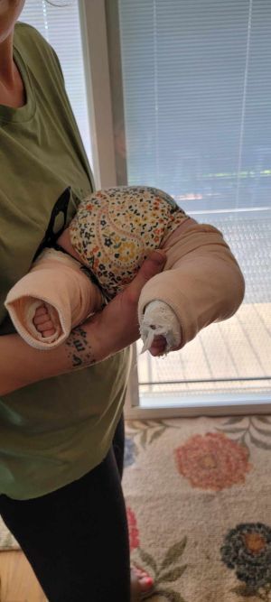 Holding Baby With Clubfoot Casts Prone Showing Toes in Casts