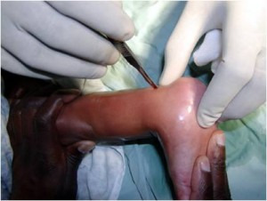 Achilles Tenotomy Surgical Procedure